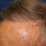 Hair Restoration Before & After Patient #6344