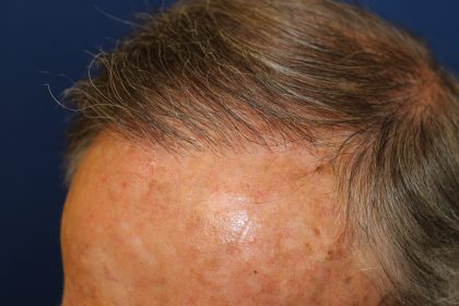 Hair Restoration Before & After Patient #6344