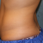 Liposuction Before & After Patient #6333