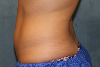 Liposuction Before & After Patient #6333