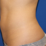 Liposuction Before & After Patient #6333
