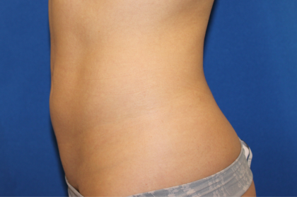 Liposuction Before & After Patient #6333