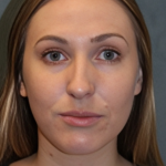 Rhinoplasty Before & After Patient #6370