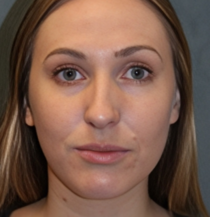Rhinoplasty Before & After Patient #6370