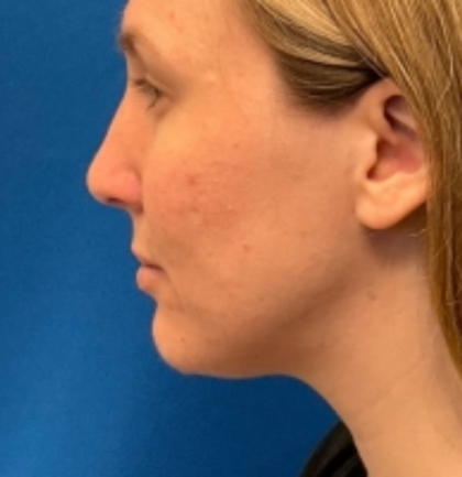 Rhinoplasty Before & After Patient #6370