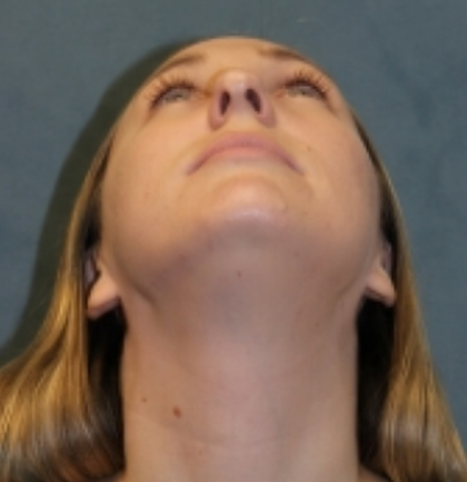 Rhinoplasty Before & After Patient #6370