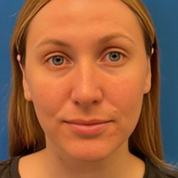 Rhinoplasty Before & After Patient #6370