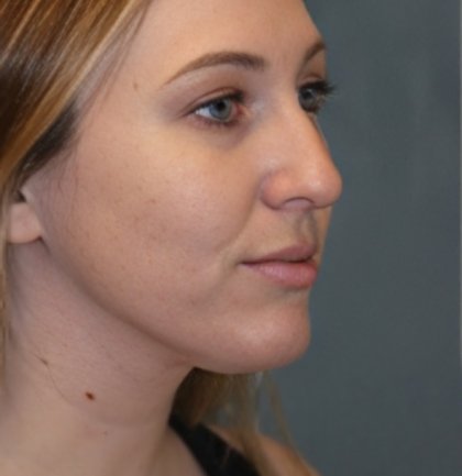 Rhinoplasty Before & After Patient #6370