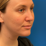 Rhinoplasty Before & After Patient #6370
