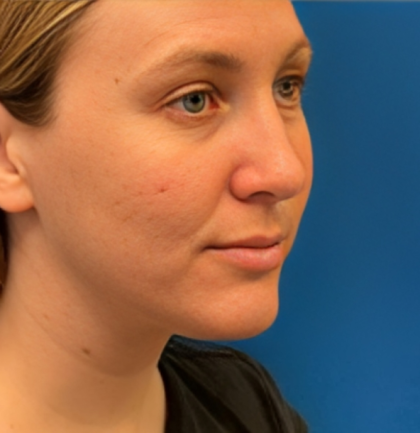 Rhinoplasty Before & After Patient #6370