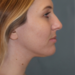 Rhinoplasty Before & After Patient #6370