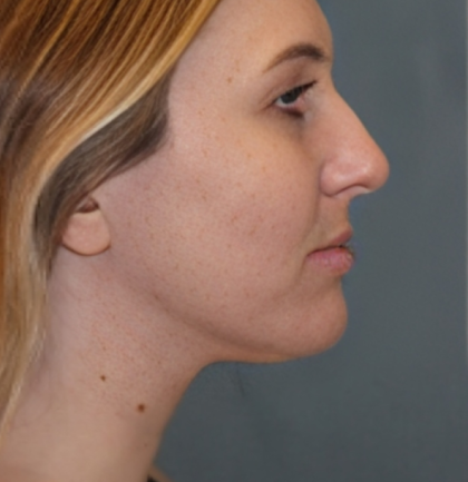 Rhinoplasty Before & After Patient #6370