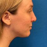 Rhinoplasty Before & After Patient #6370