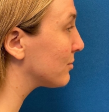 Rhinoplasty Before & After Patient #6370