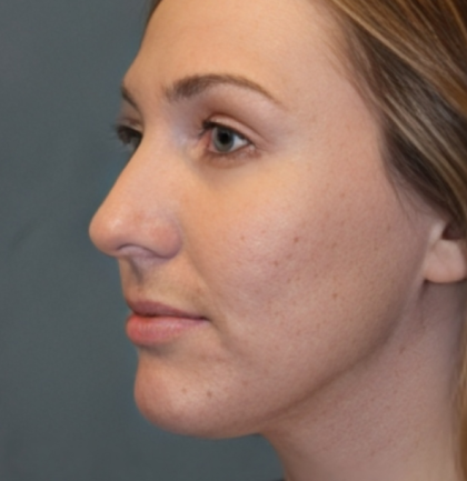 Rhinoplasty Before & After Patient #6370