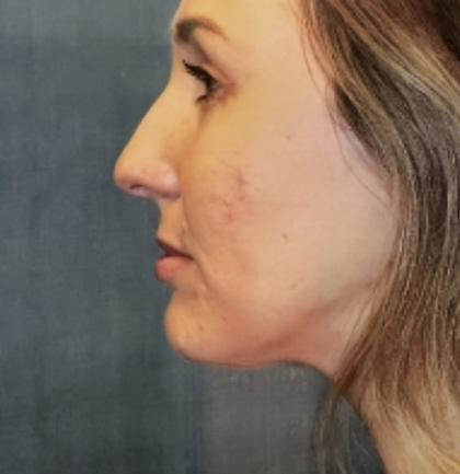 Rhinoplasty Before & After Patient #6370