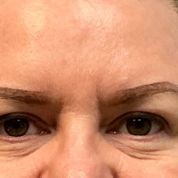 Blepharoplasty Before & After Patient #6546