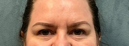 Blepharoplasty Before & After Patient #6546