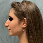 Rhinoplasty Before & After Patient #6539