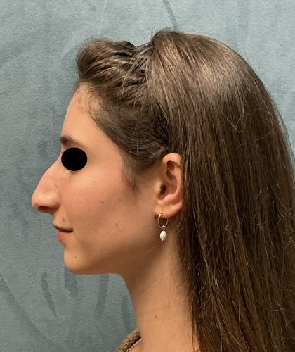 Rhinoplasty Before & After Patient #6539