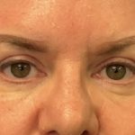 Blepharoplasty Before & After Patient #6546