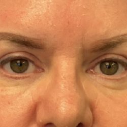 Blepharoplasty Before & After Patient #6546