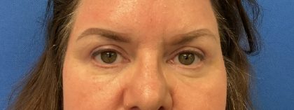 Blepharoplasty Before & After Patient #6546
