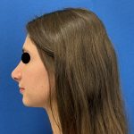 Rhinoplasty Before & After Patient #6539
