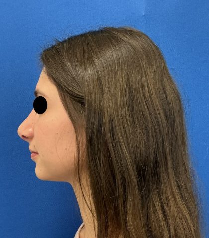 Rhinoplasty Before & After Patient #6539