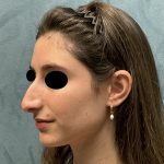 Rhinoplasty Before & After Patient #6539