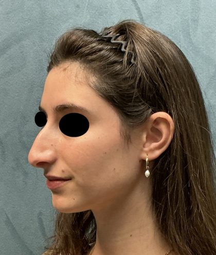 Rhinoplasty Before & After Patient #6539