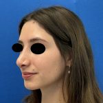Rhinoplasty Before & After Patient #6539