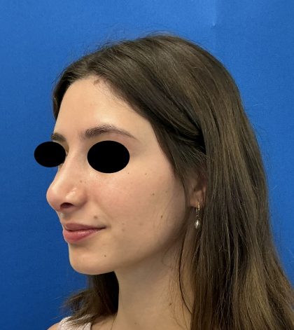 Rhinoplasty Before & After Patient #6539