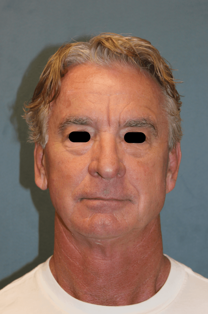 Facelift Before & After Patient #6506