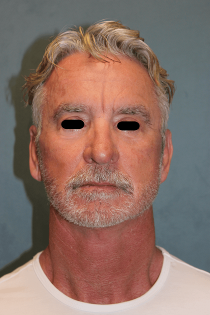 Facelift Before & After Patient #6506