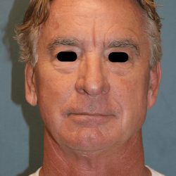 Facelift Before & After Patient #6506