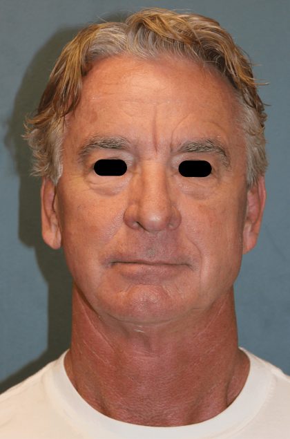 Facelift Before & After Patient #6506