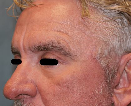 Facelift Before & After Patient #6506