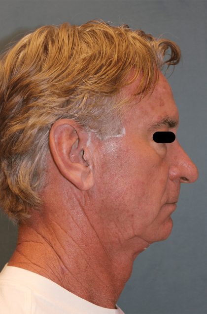 Facelift Before & After Patient #6506
