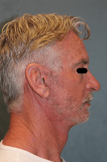 Facelift Before & After Patient #6506