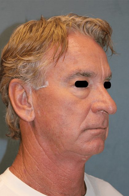 Facelift Before & After Patient #6506