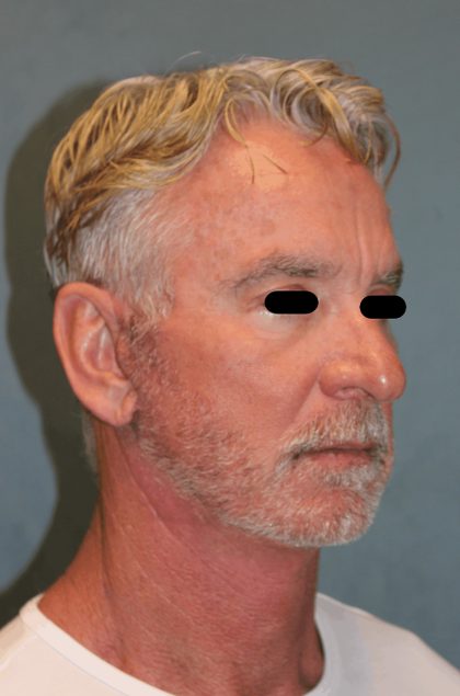 Facelift Before & After Patient #6506