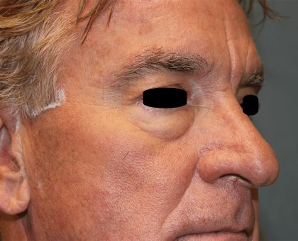 Facelift Before & After Patient #6506