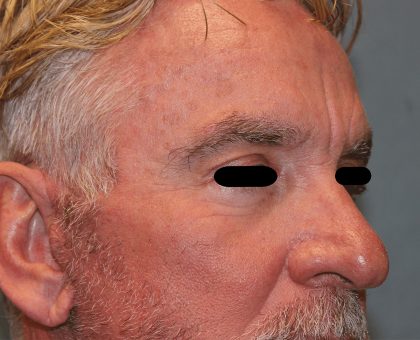 Facelift Before & After Patient #6506