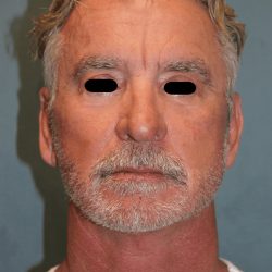 Facelift Before & After Patient #6506