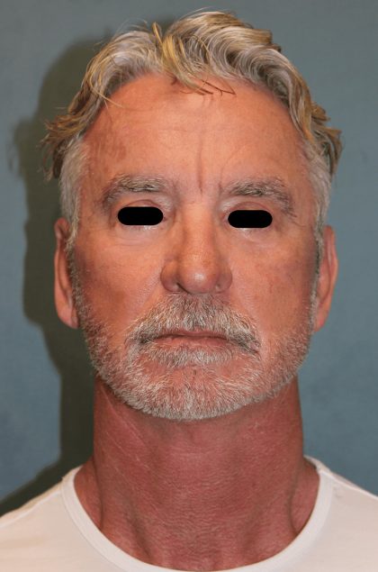 Facelift Before & After Patient #6506
