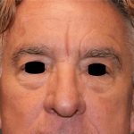Facelift Before & After Patient #6506