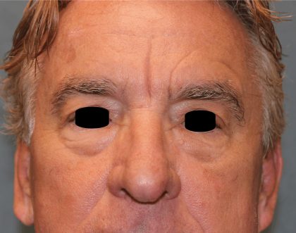 Facelift Before & After Patient #6506