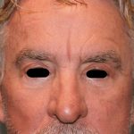 Facelift Before & After Patient #6506