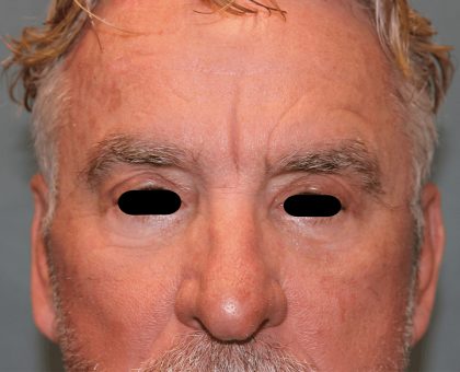 Facelift Before & After Patient #6506
